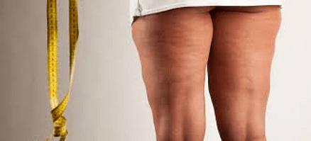 Κυτταρίτιδα: γνωρίζουμε τον μεγαλύτερο εχθρό&nbsp;μας.